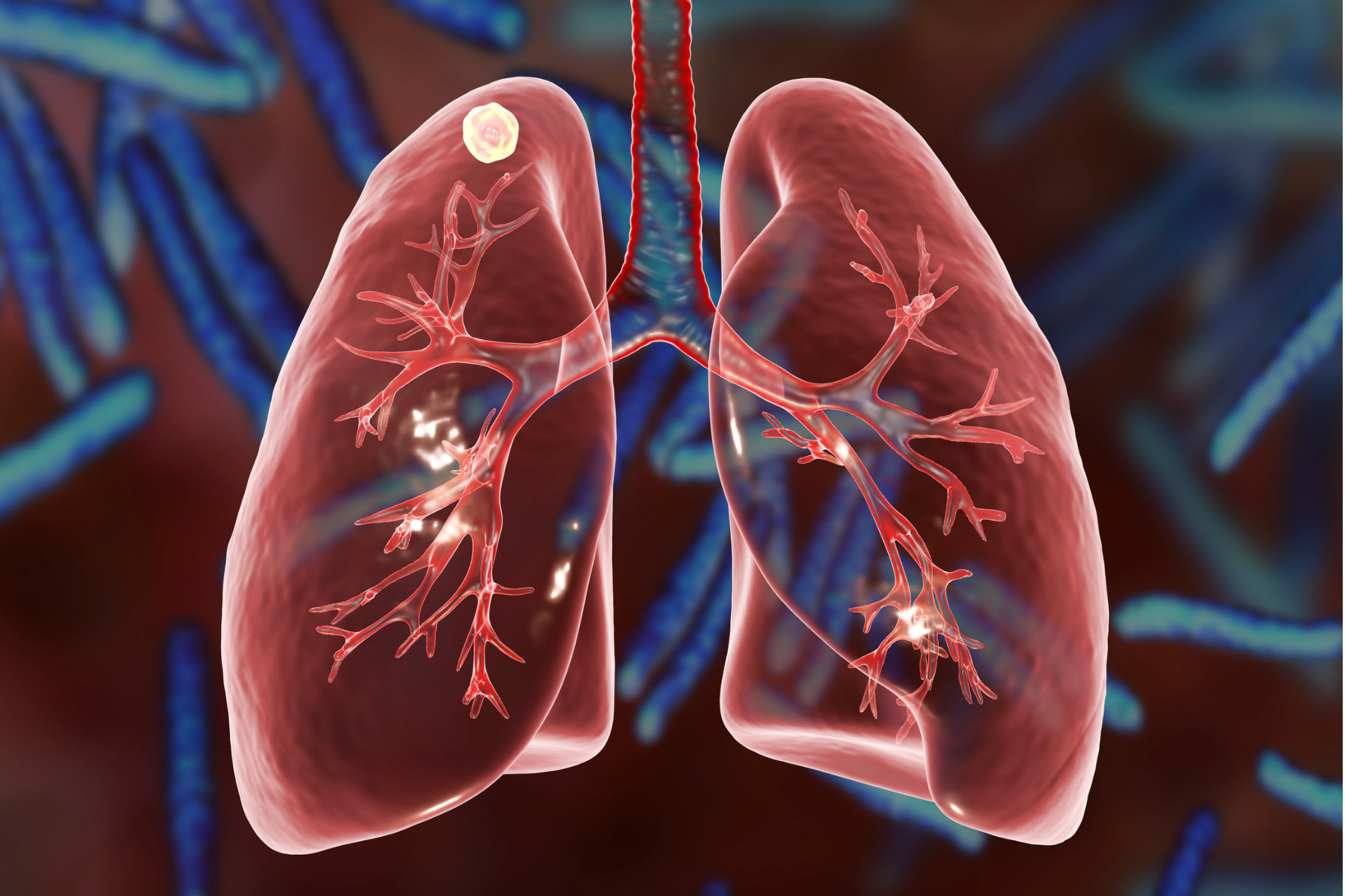 Tuberculose pulmonar – Sistema imune do hospedeiro e testes laboratoriais